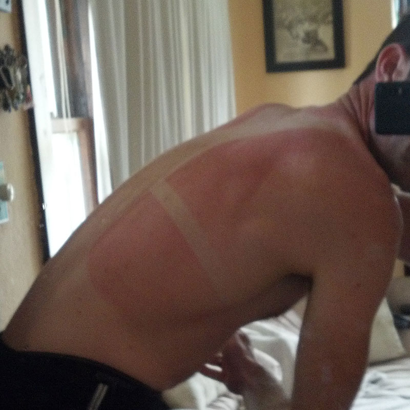 sunburn